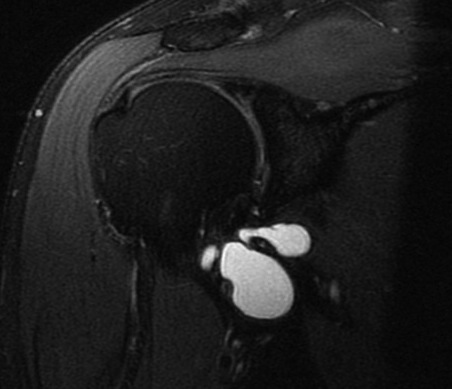 Figure 4 for case Axillary cyst and denervation